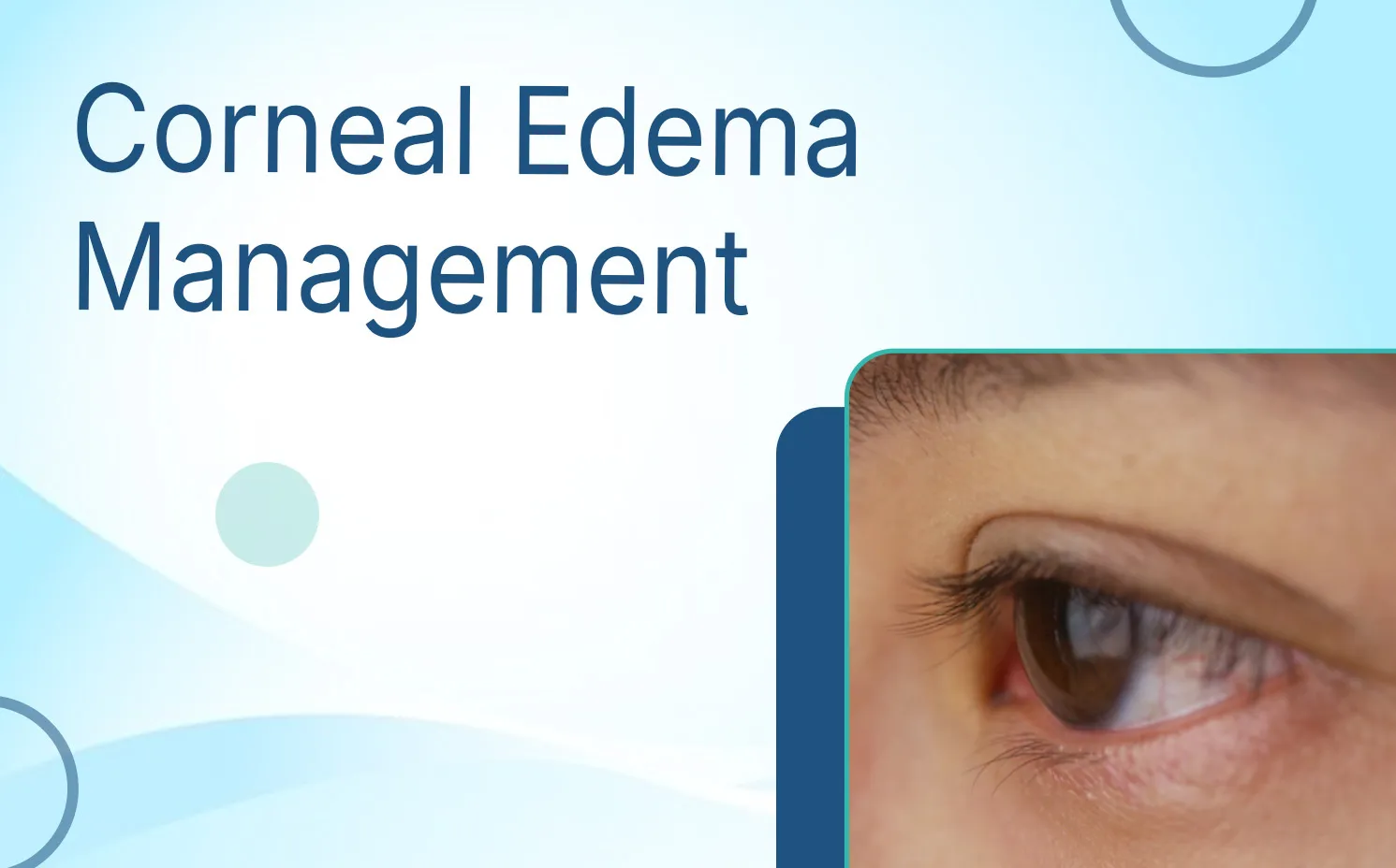Corneal Edema Management