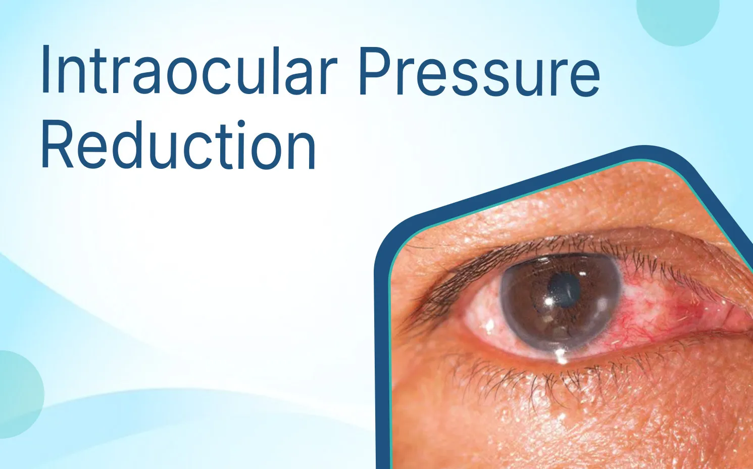 Intraocular Pressure Reduction