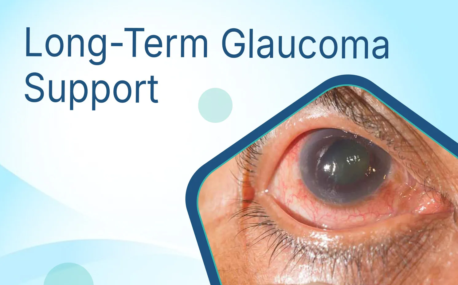 Long-Term Glaucoma Support